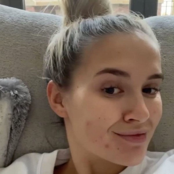 5 Love Island Stars Who Got Real About Their Skin