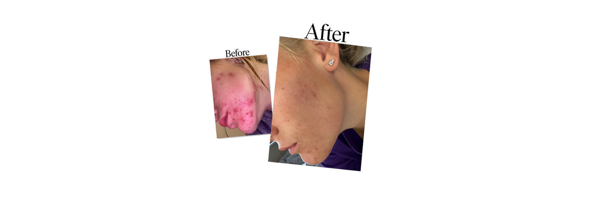 Chloe - Real Skin Stories