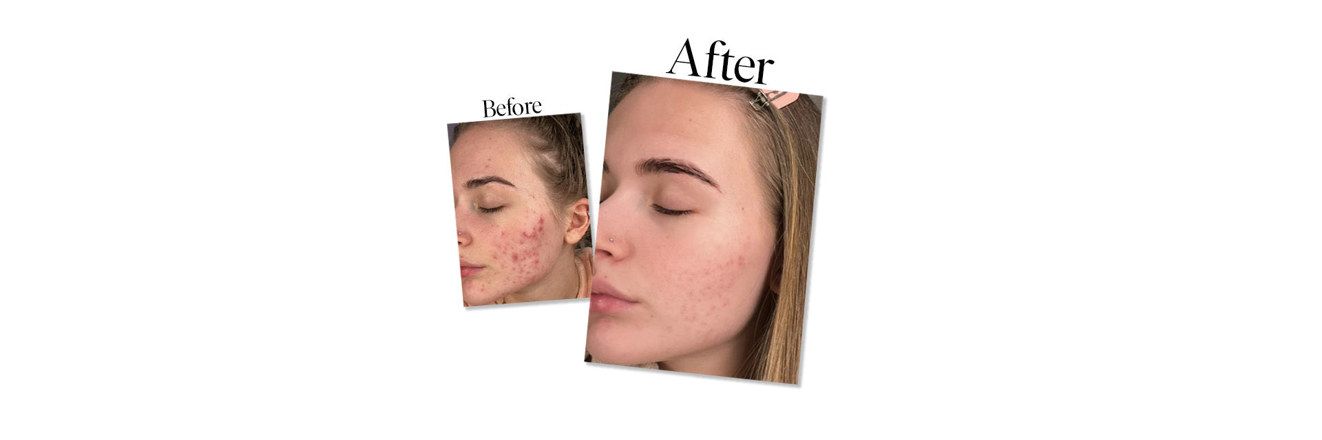 Mia - Real Skin Stories