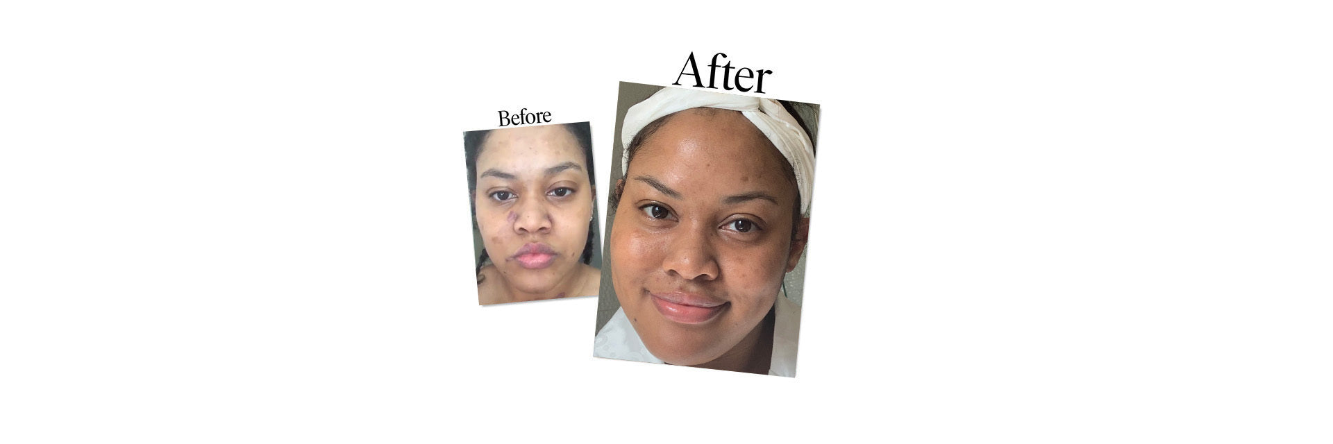 Nicole - Real Skin Stories
