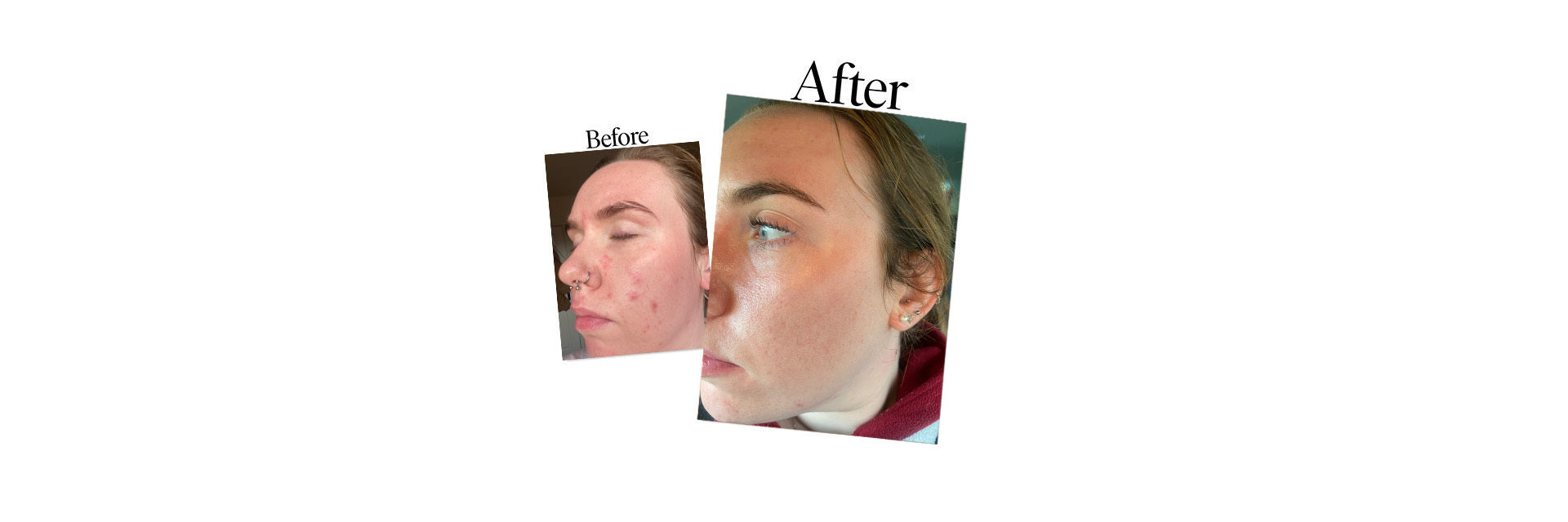 Pippa - Real Skin Stories