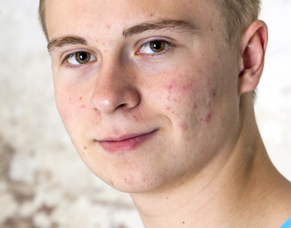 Helping your teen through blemishes