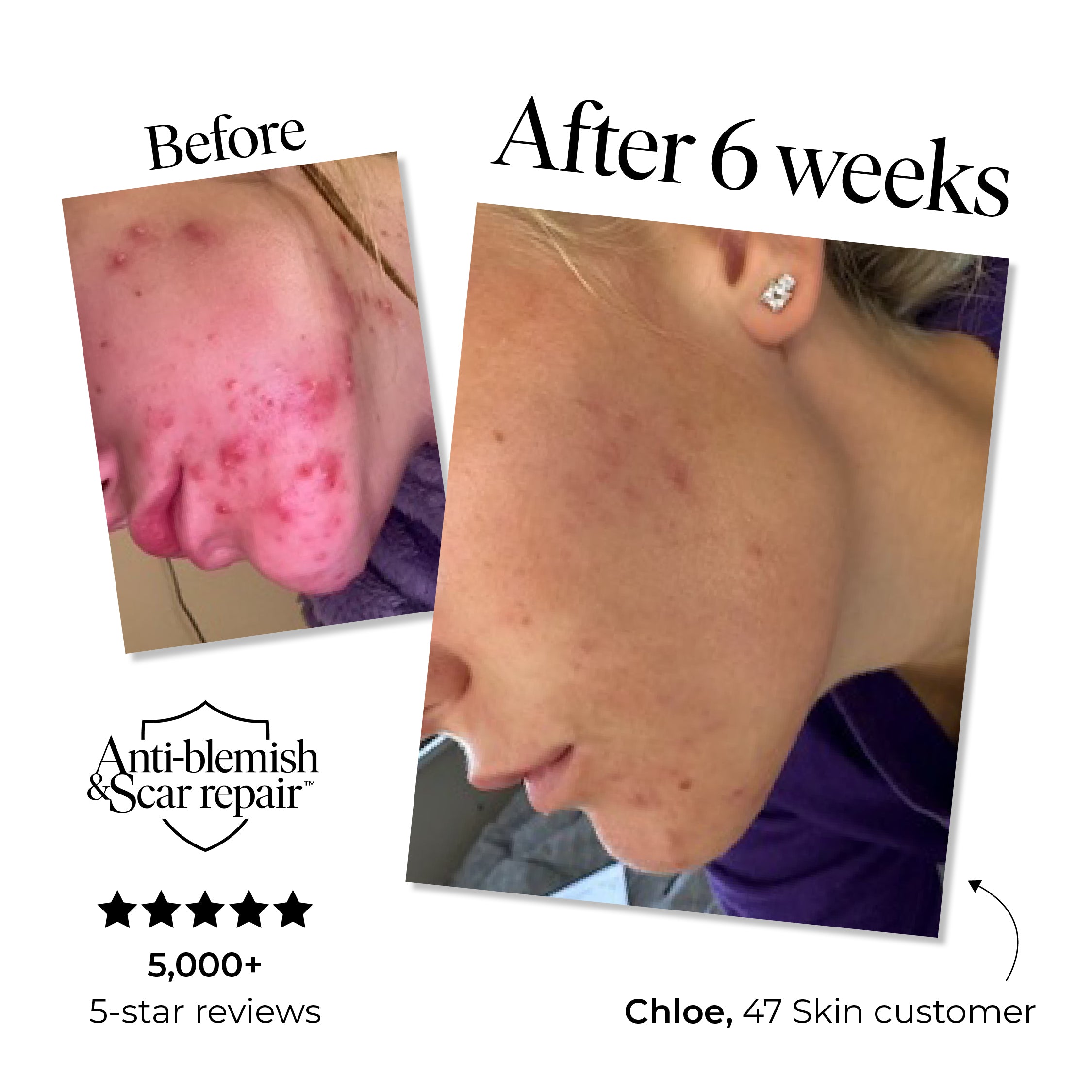 2 Step Treatment Bundle