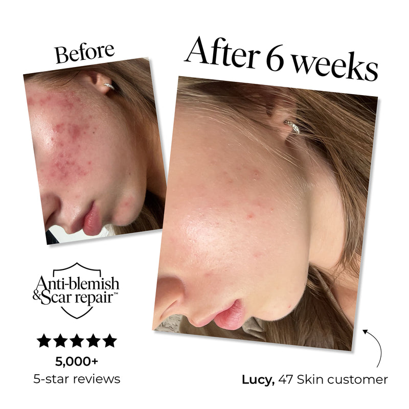 3 Step Treatment Bundle