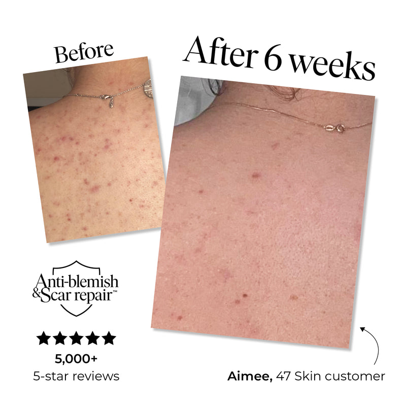 Anti-Blemish & Scar Repair Body Moisturiser