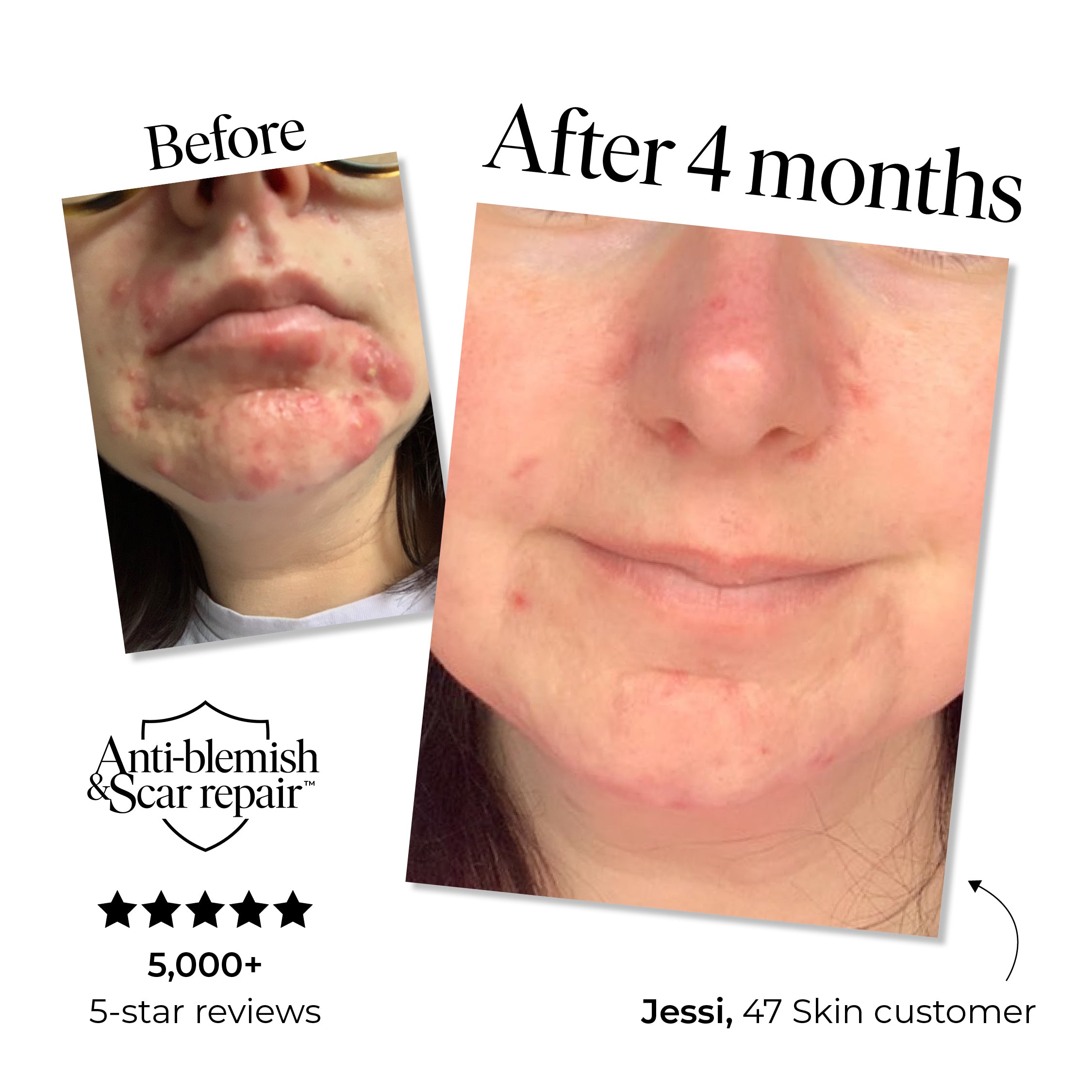 Exfoliating Skin Treatment for persistent, stubborn and cystic blemishes