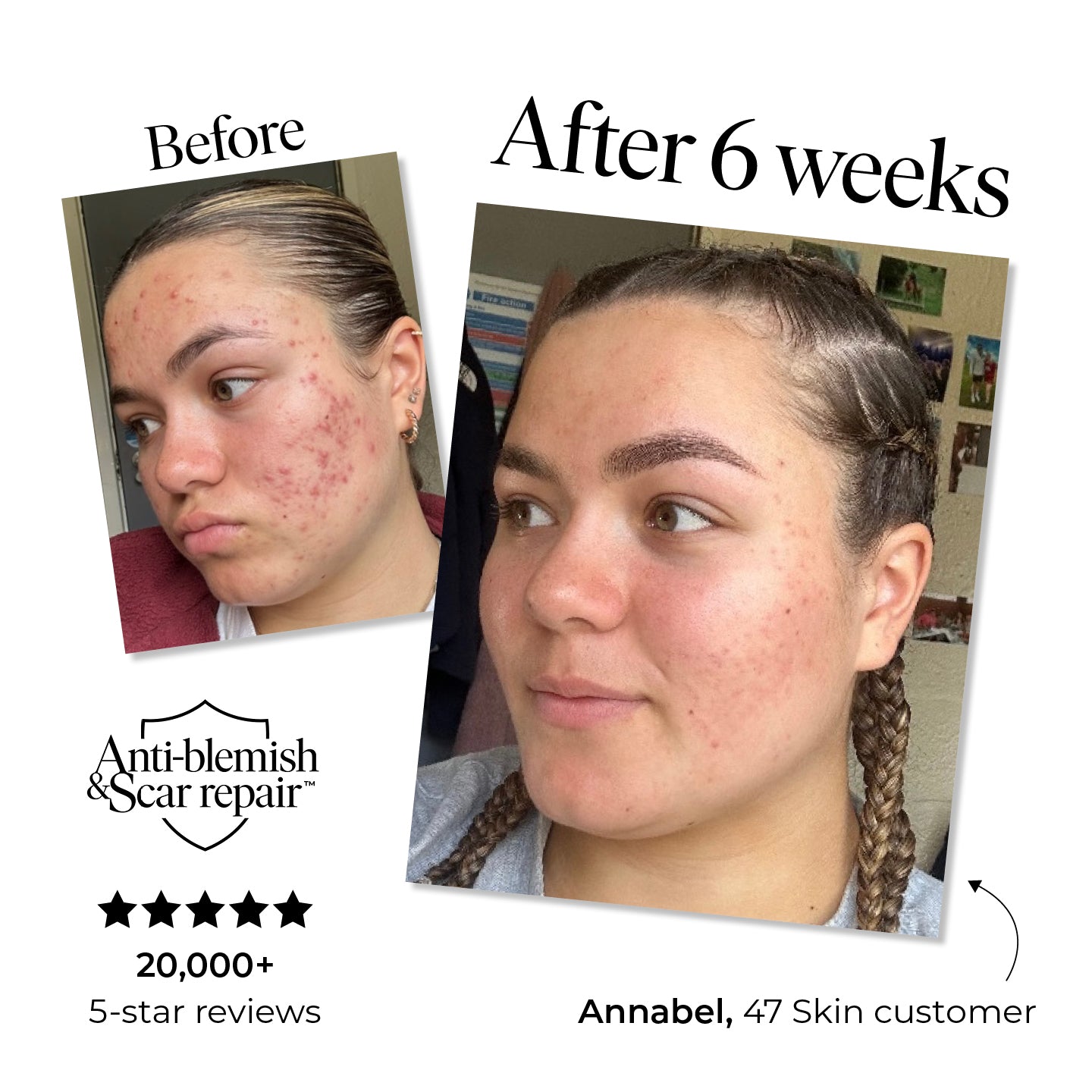 #1 Best Seller: Anti-Blemish & Scar Repair Serum