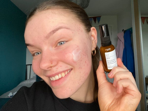 "Finding Skin Positivity Changed My Life" - Meet Poppy