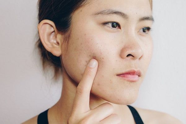 7 Ways to Prevent Blemish Scars