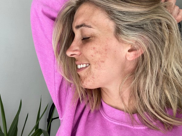 3 top tips for coping with blemishes