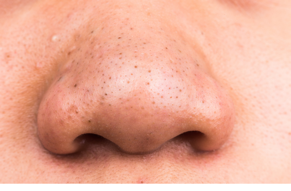 How to get rid of blackheads