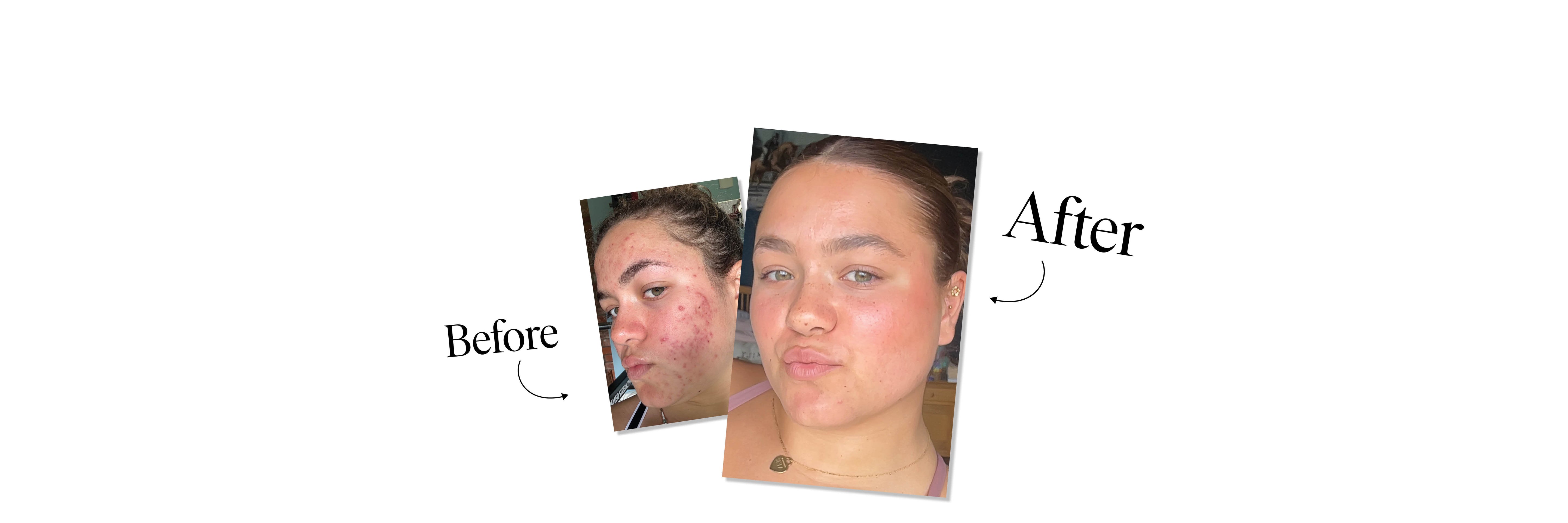 Annabel, Rugby Player - Real Skin Stories