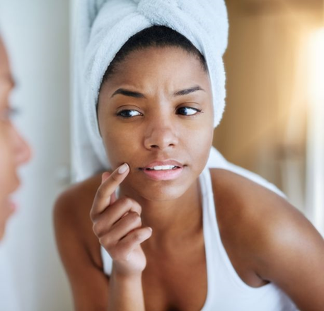 Adult acne: why it happens and how to get rid of it