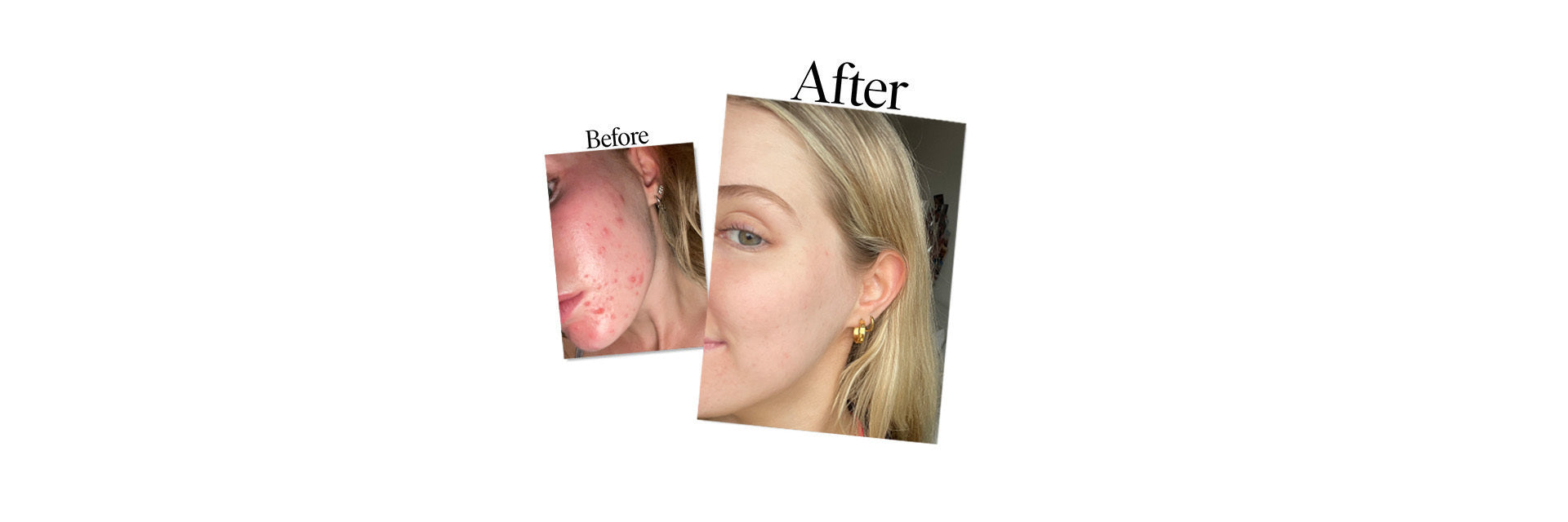 Rebecca - Real Skin Stories