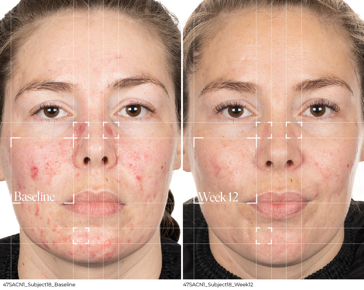 Before and Week 12 clinical result