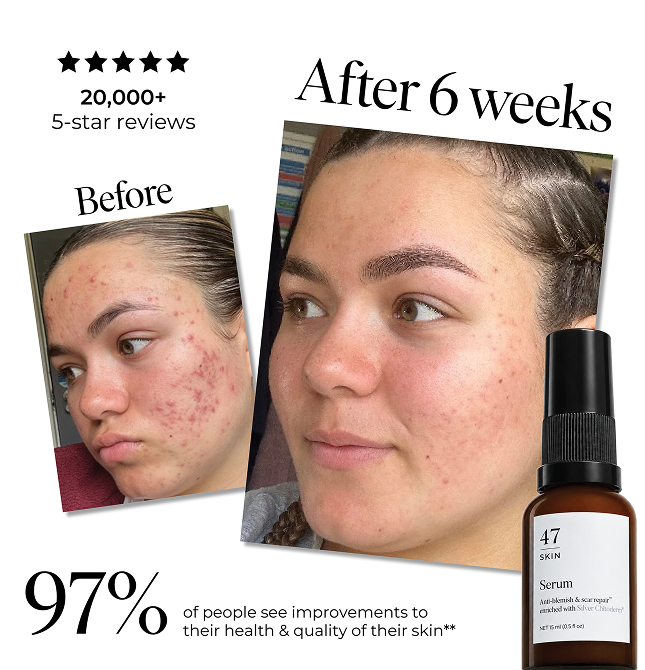 97% of people see visible improvements to their skin.* Now your teenager can try it for £10.