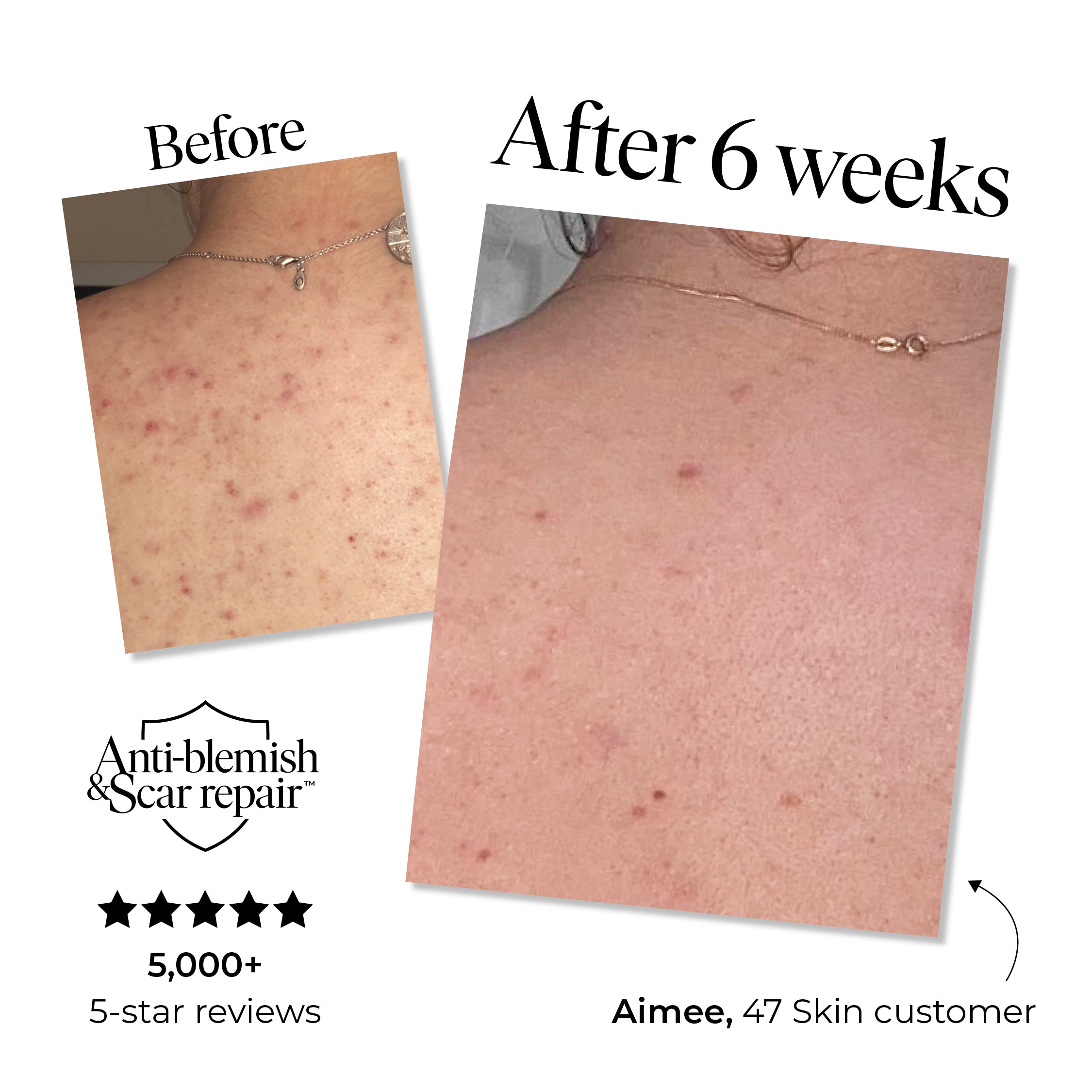 Anti-Blemish & Scar Repair Body Moisturiser