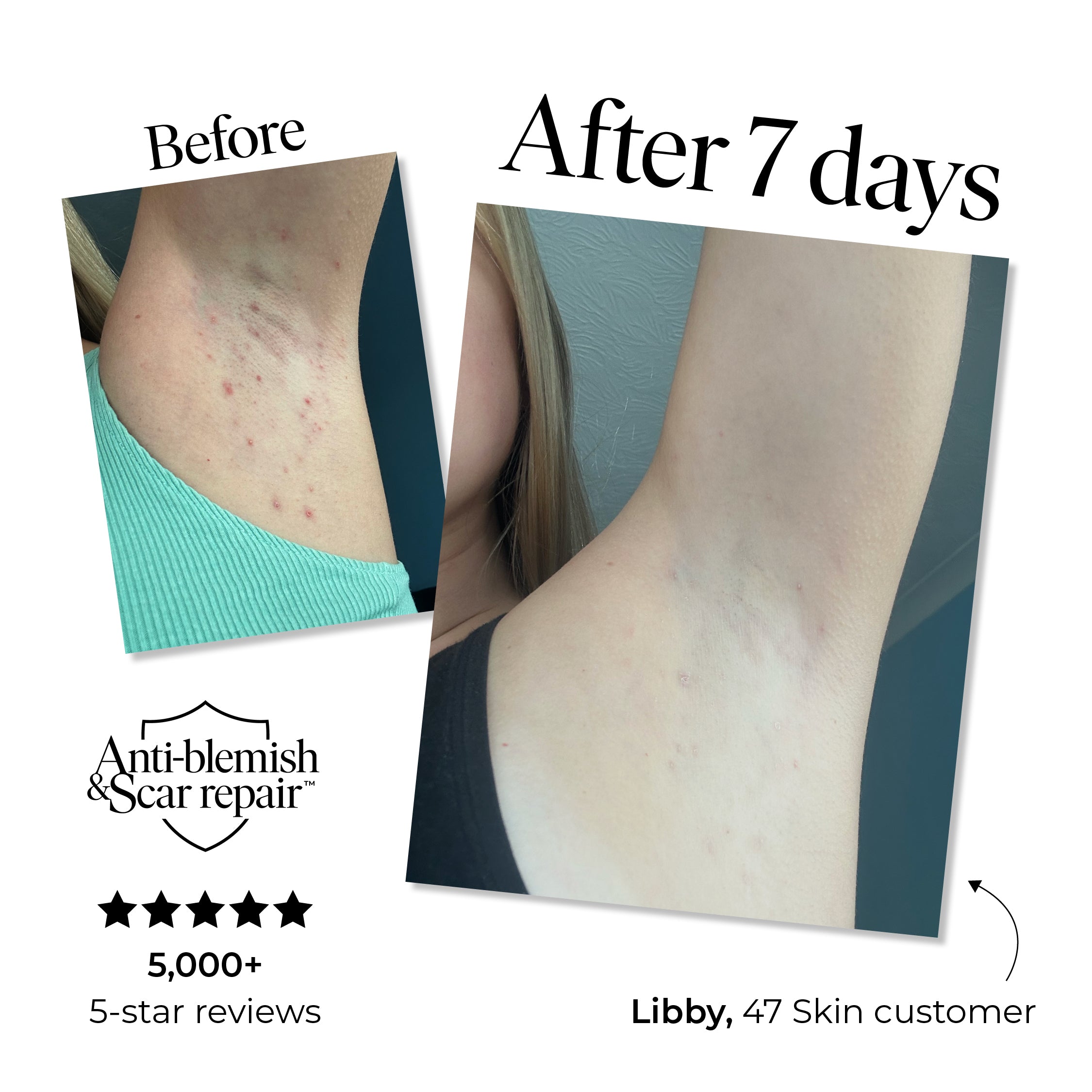 Trial Size Anti-Blemish & Scar Repair Body Moisturiser (10ml)