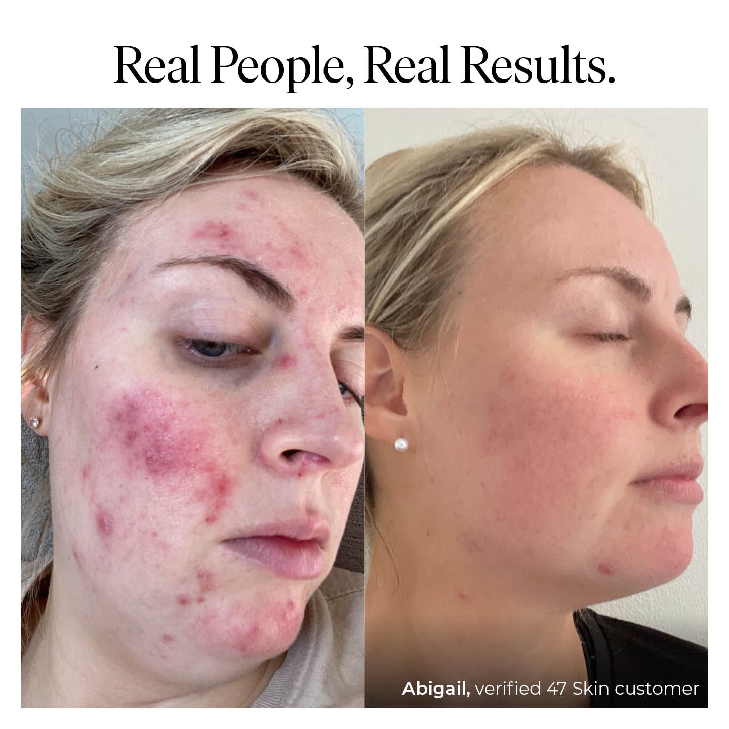 Anti-Blemish & Scar Repair Everyday Cleanser