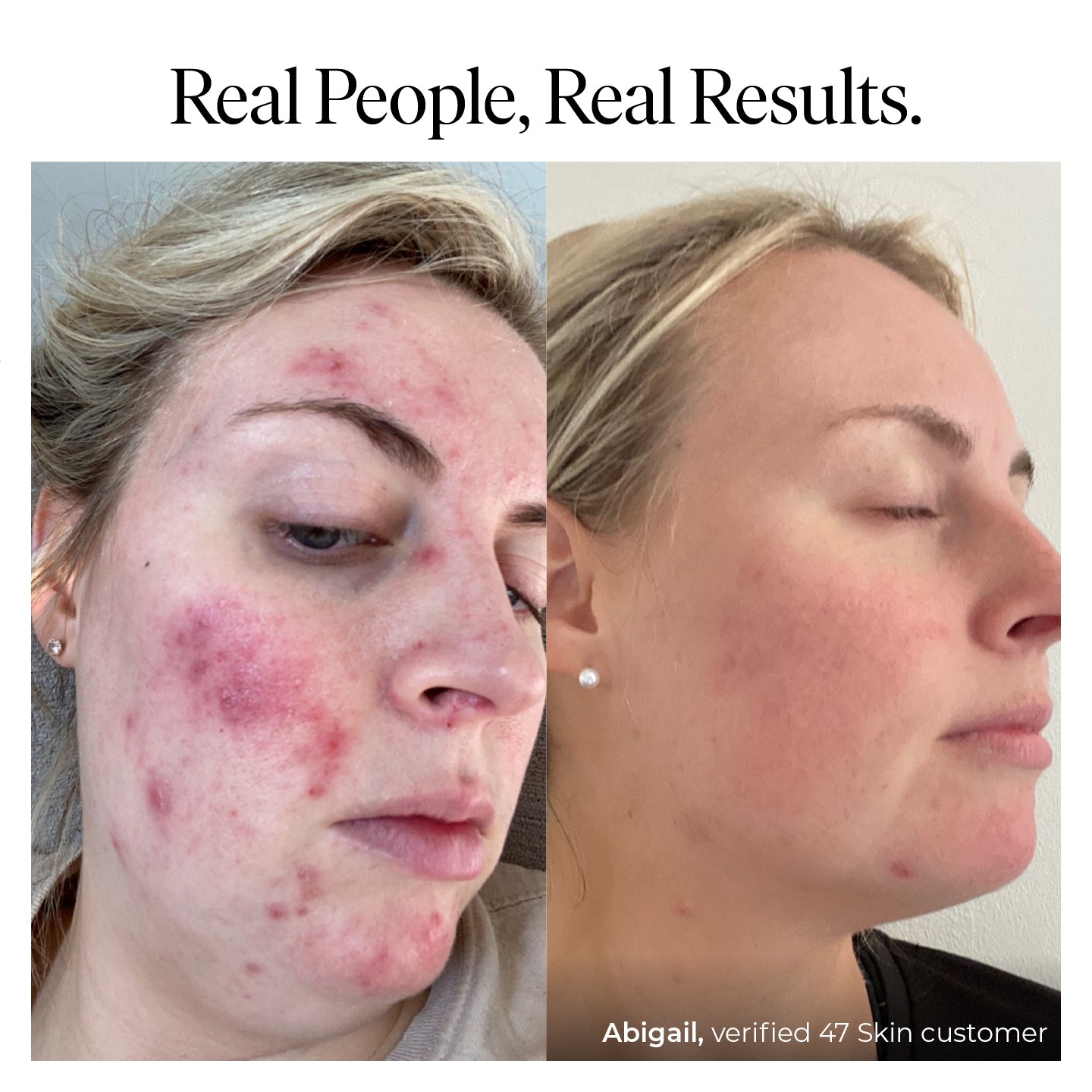 Anti-Blemish & Scar Repair Everyday Cleanser