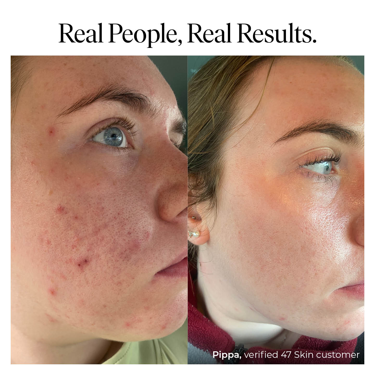 Anti-Blemish & Scar Repair Daily Moisturiser