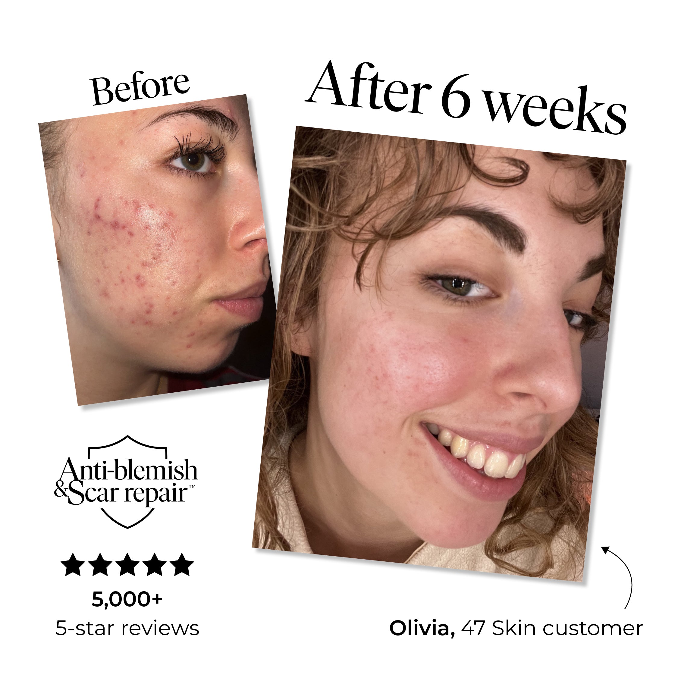 Anti-Blemish & Scar Repair Daily Moisturiser