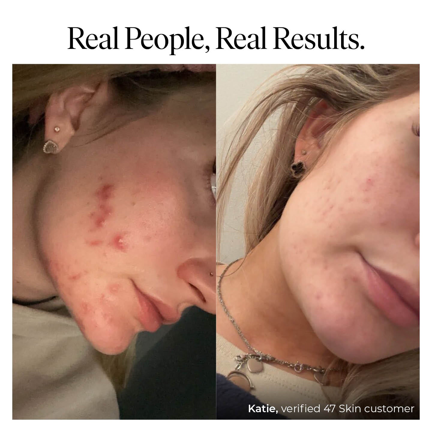 Exfoliating Skin Treatment for persistent, stubborn and cystic blemishes