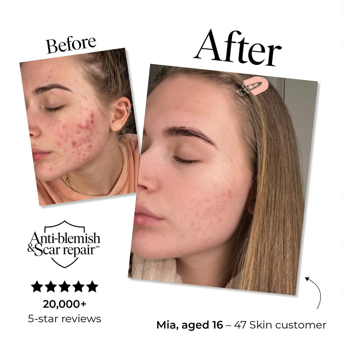 Mum-Approved Trial Size Anti-Blemish & Scar Repair Serum for Teen Skin