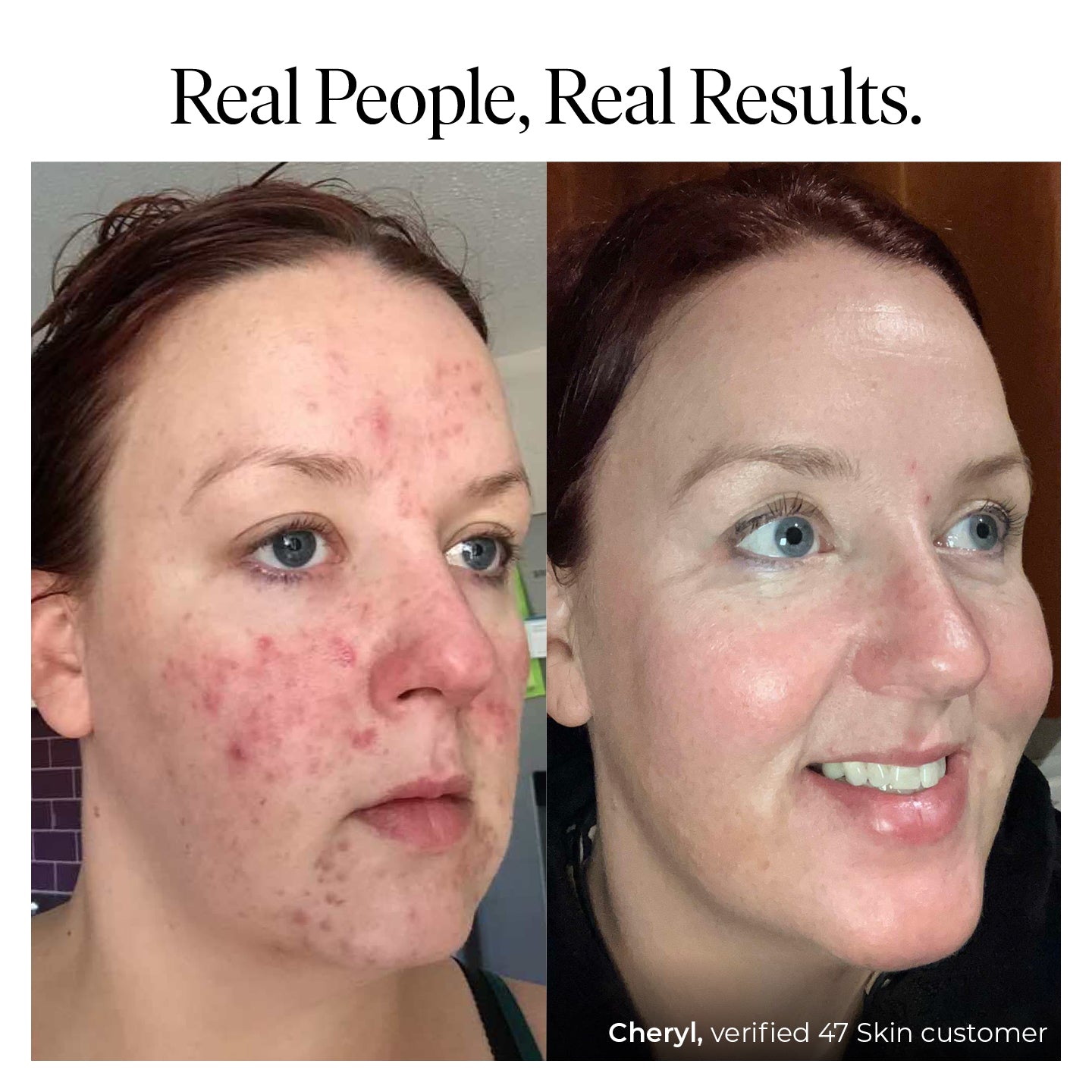 Treatment serum for persistent, stubborn and cystic blemishes
