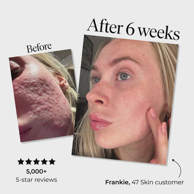 Anti-Blemish and Scar Repair Silver Mask