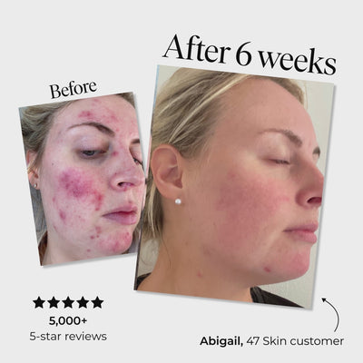 2 Step Treatment Bundle